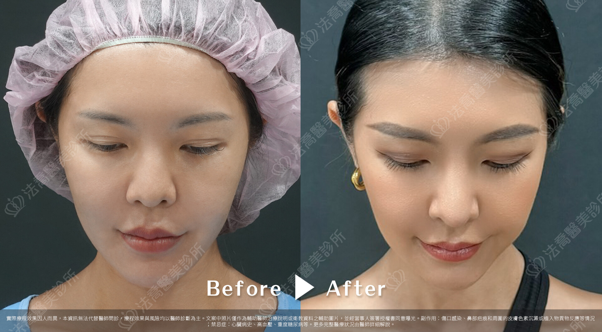 自體肋骨隆鼻、鼻截骨、縮鼻翼