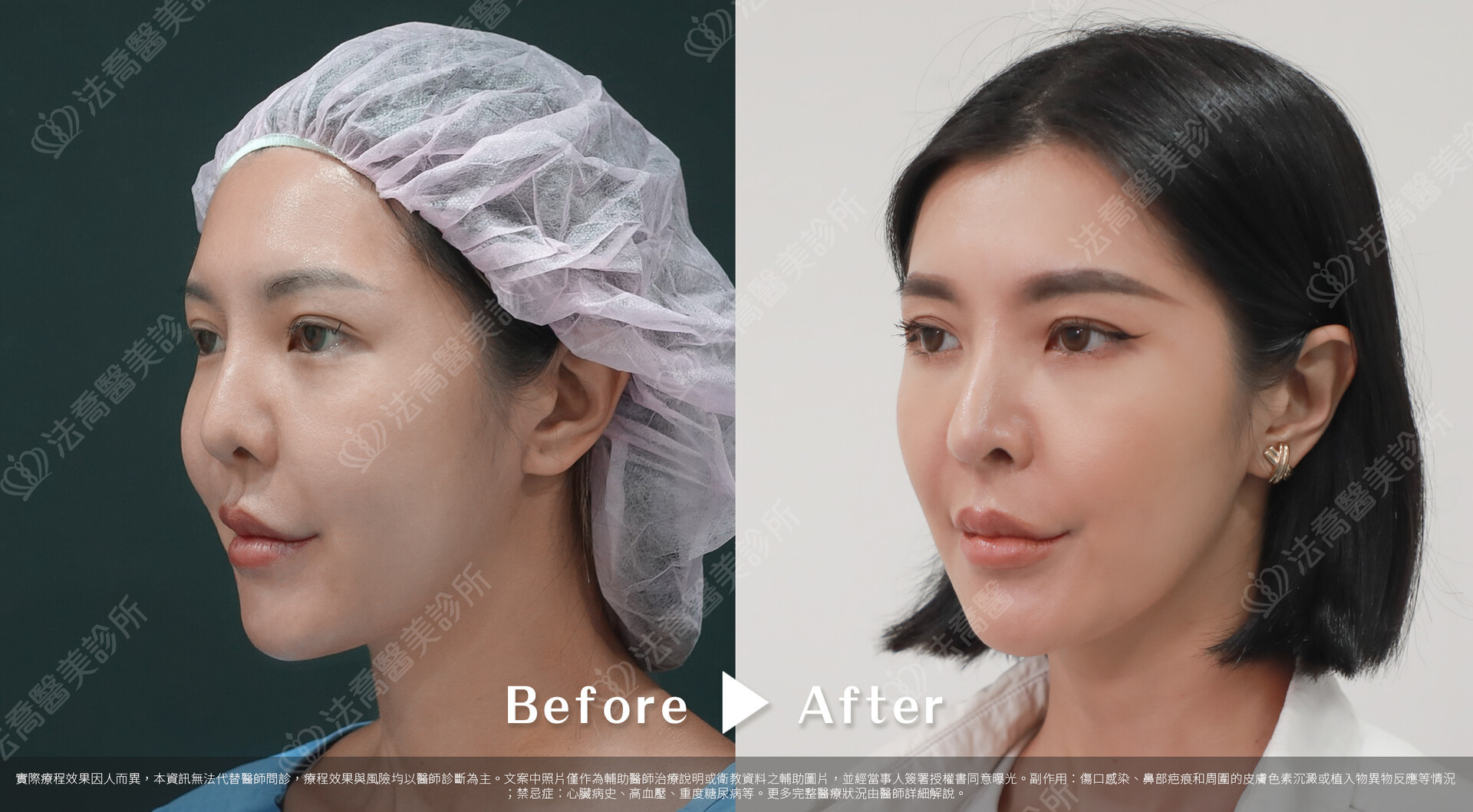 自體肋骨隆鼻、鼻截骨、縮鼻翼