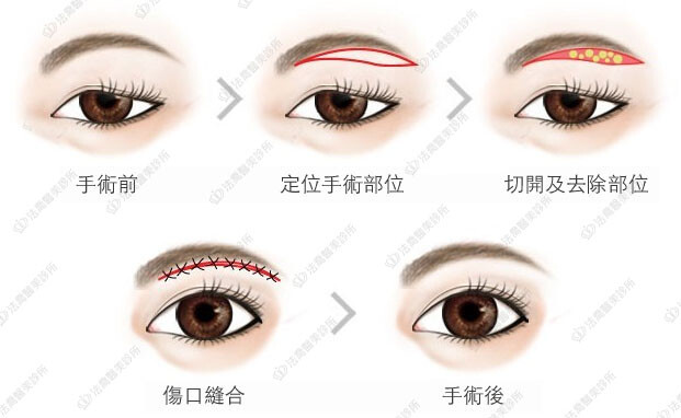 切眉手術方式