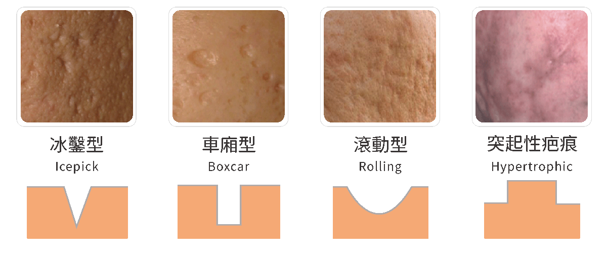 凹陷型疤痕型態分類