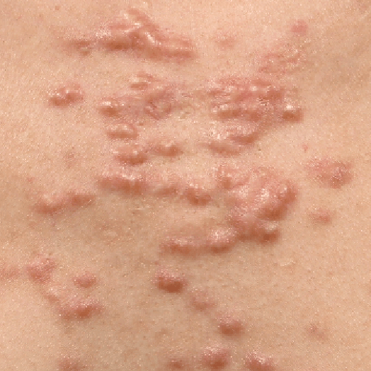 肥厚性疤痕案例