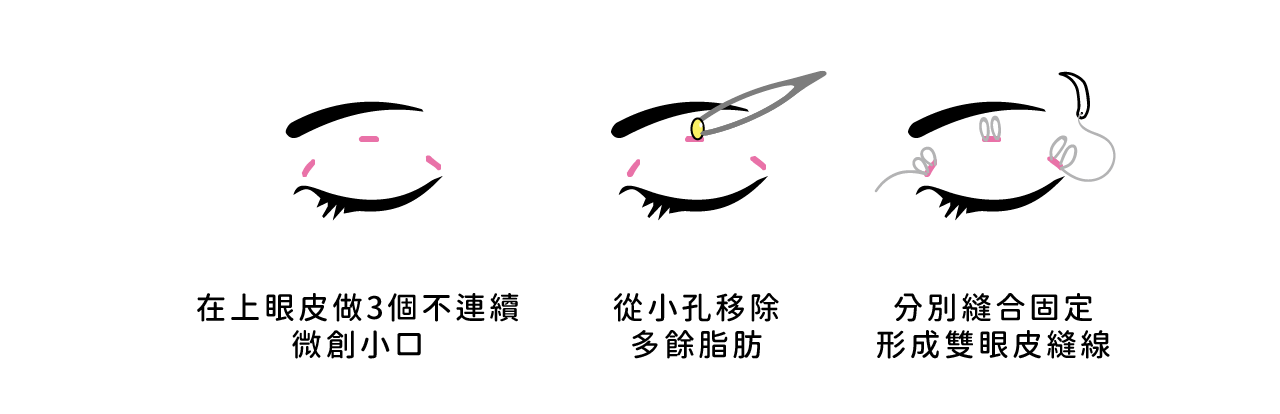 三切口手術方式