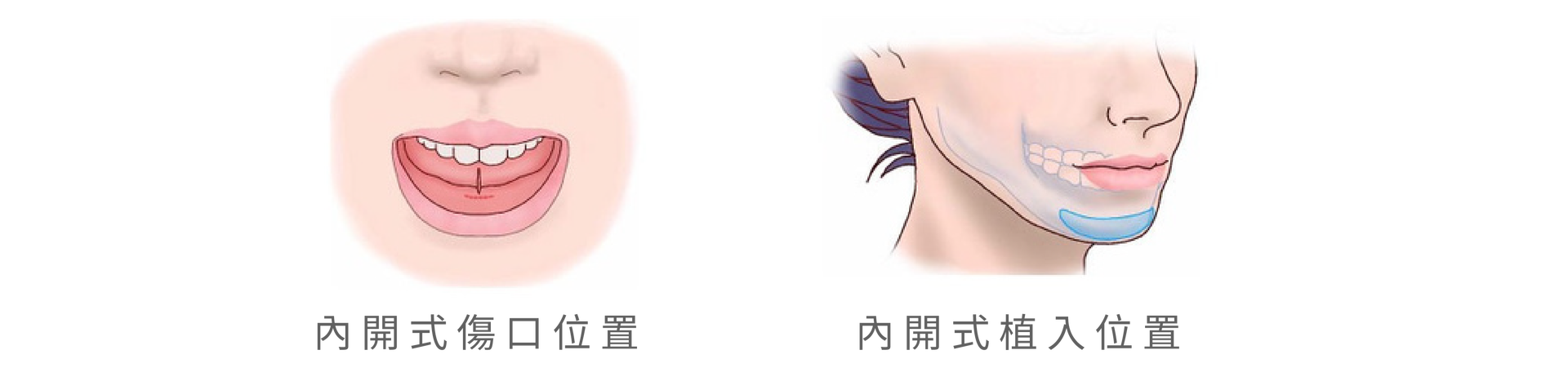 內開及外開墊下巴傷口位置