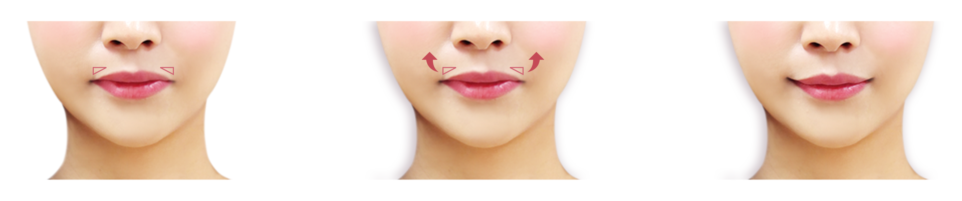 唇部微笑線手術原理