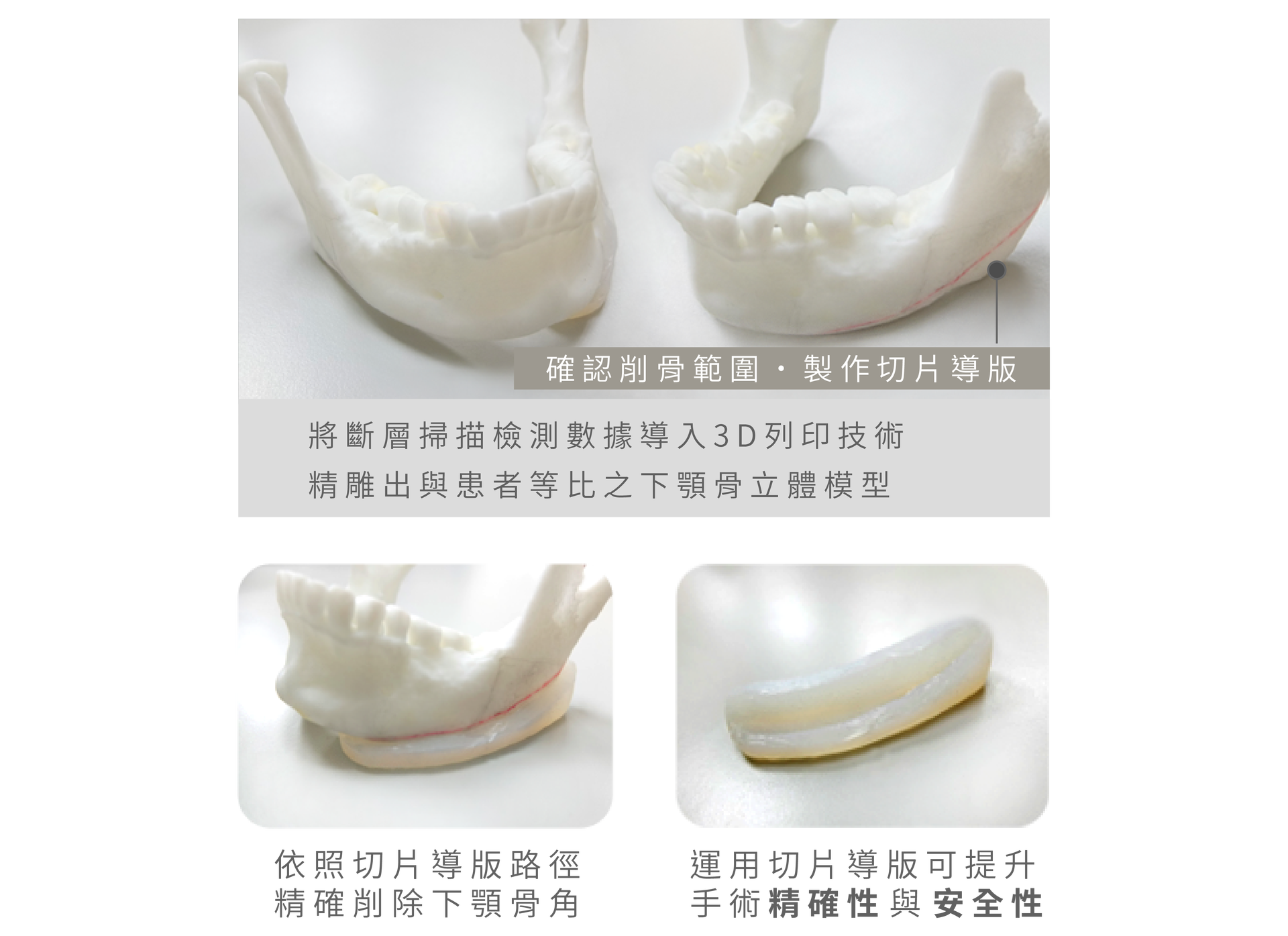 3D列印下顎模型
