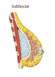 隆乳植入物置於筋膜下