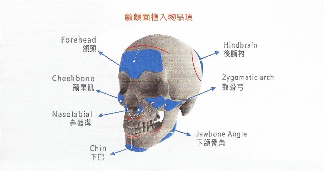 客製化臉部植入物手術