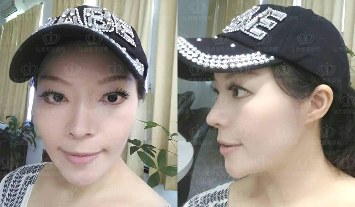 深部筋膜拉皮案例