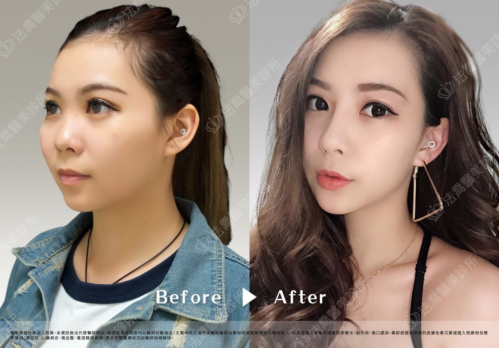 法喬肋骨隆鼻案例照