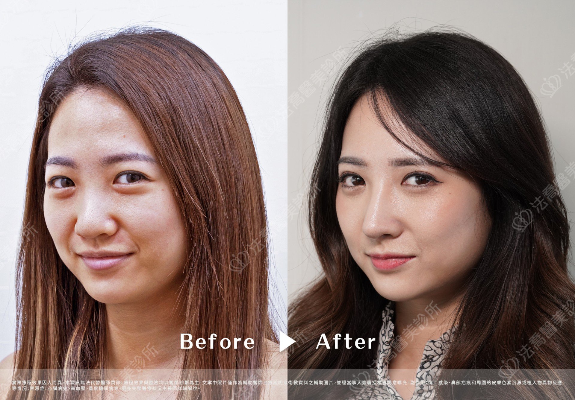 法喬肋骨隆鼻案例